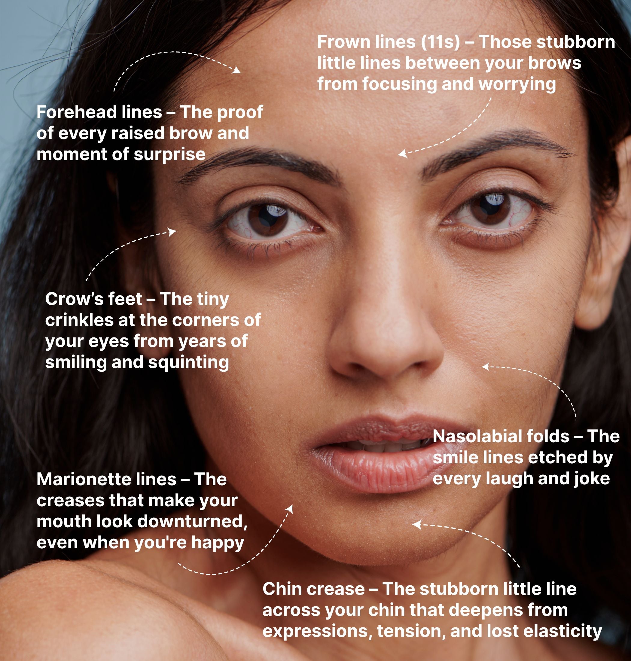 Diagram of fine lines and wrinkle areas on a woman’s face including forehead lines, 11s, crow’s feet, nasolabial folds, and marionette lines